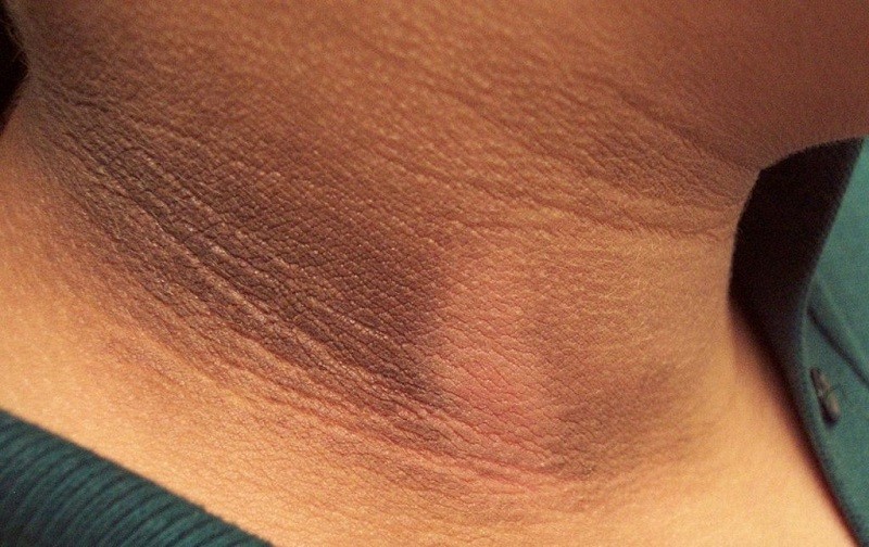 تیرگی پوست - پیگمانتاسیون - درمان تیرگی پوست